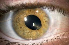 types of cataract